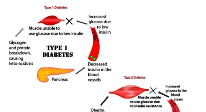 Differences Between Type 1 And Type 2 Diabetes