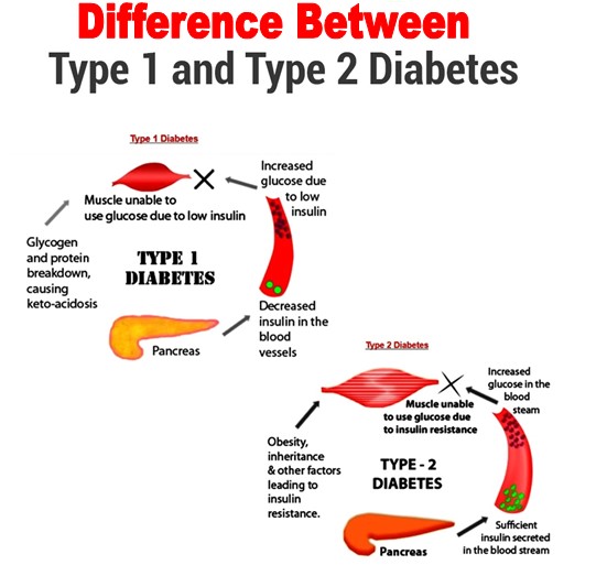 Differences Between Type 1 And Type 2 Diabetes